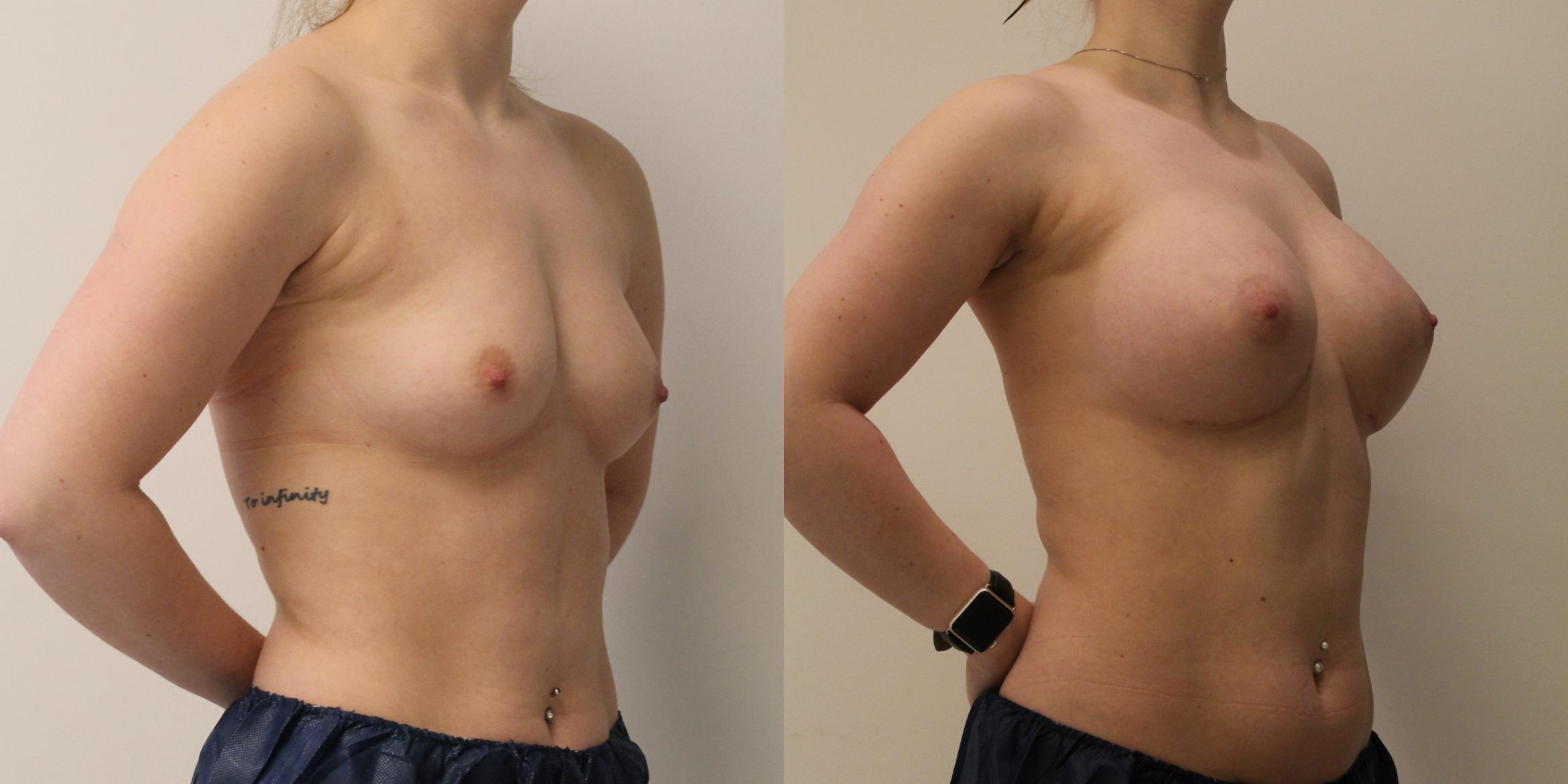 Enhance the Size and Shape of Your Breast With Breast Augmentation in Fort ...